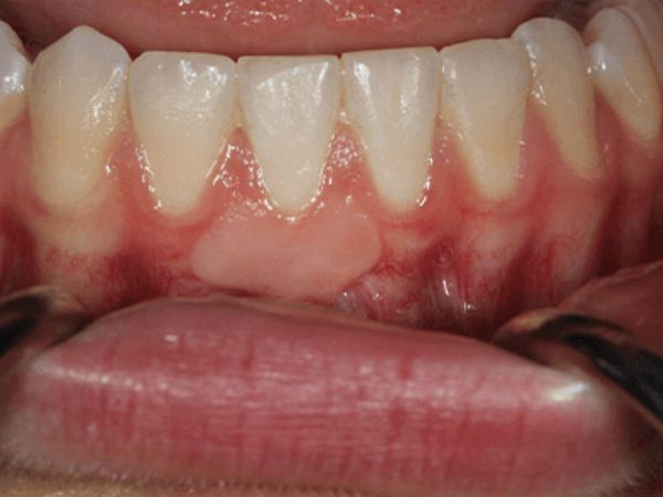 After gum treatment