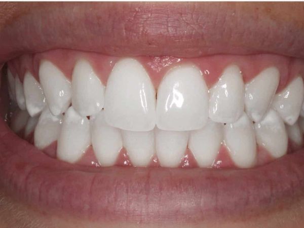 After teeth whitening treatment